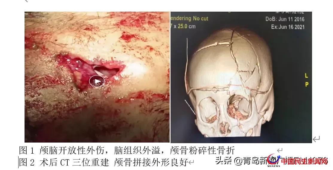 5歲男童6樓墜落命懸一線，婦兒醫(yī)院多學科協(xié)作再勝“死神”